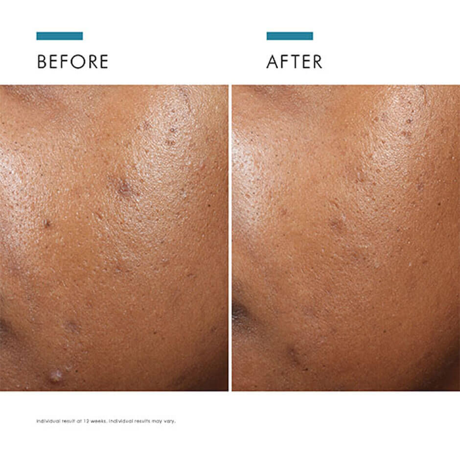 Phyto A+ Brightening Treatment 3% Azelaic Acid