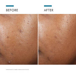 Phyto A+ Brightening Treatment 3% Azelaic Acid