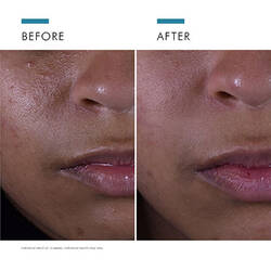 Blemish-Prone Skin Power Pair