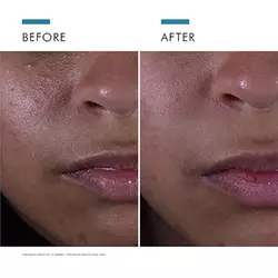 Blemish-Prone Skin Power Pair