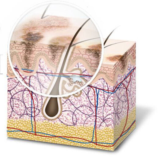 Diagram illustrating uneven skin tone and hyperpigmentation, highlighting the epidermis layer where excess melanin production leads to dark spots on the skin's surface.