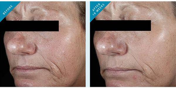 C E Ferulic before and after results