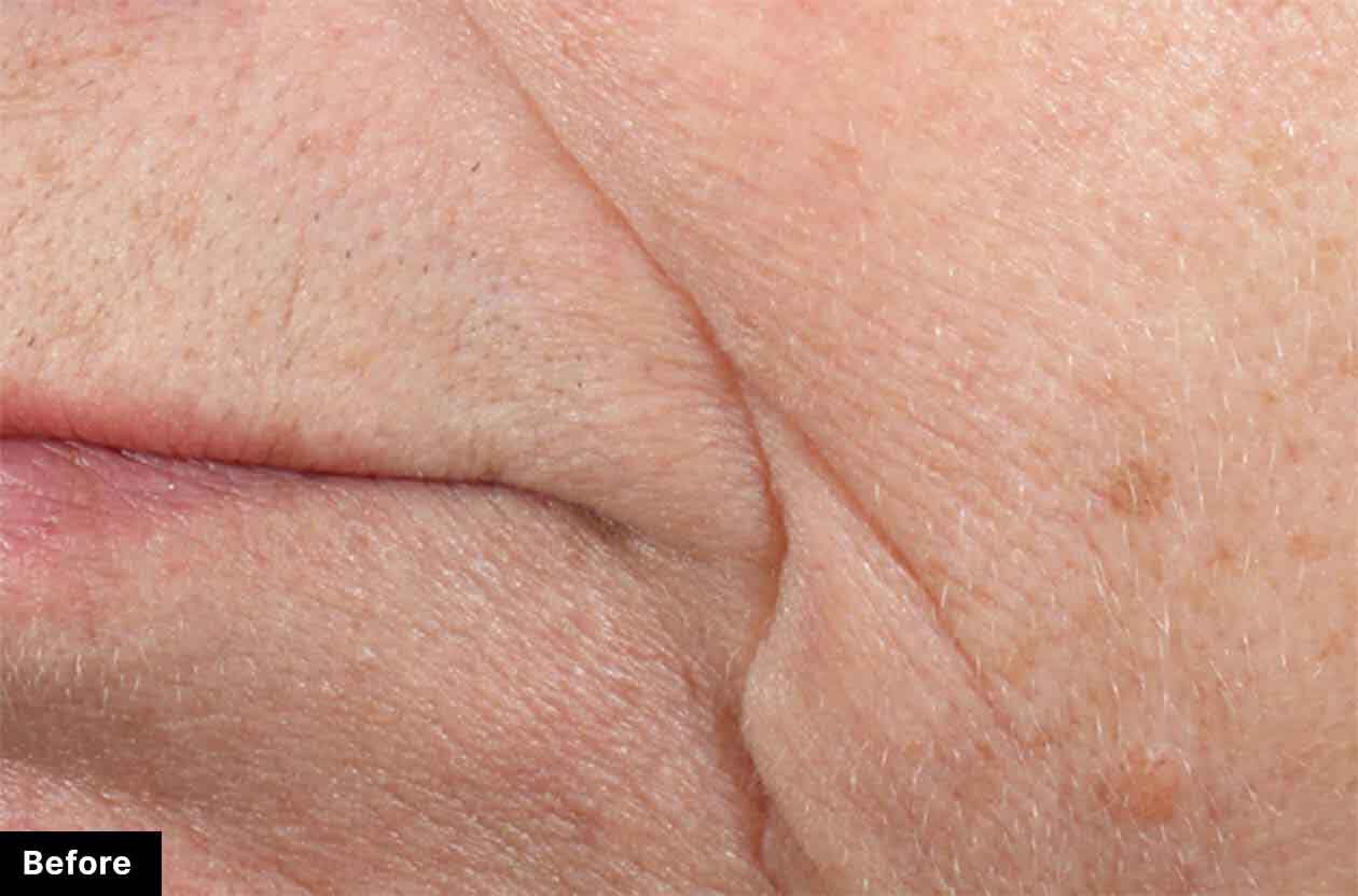 Close-up of facial skin showing noticeable wrinkles and texture before treatment.
