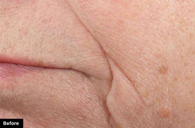 Close-up of facial skin showing noticeable wrinkles and texture before treatment.