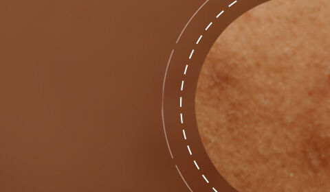Close-up of textured skin showing small imperfections against a soft, blurred brown background.