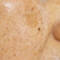 Close-up of skin with visible freckles and uneven texture.