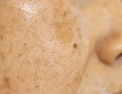 Close-up of skin with visible freckles and uneven texture.
