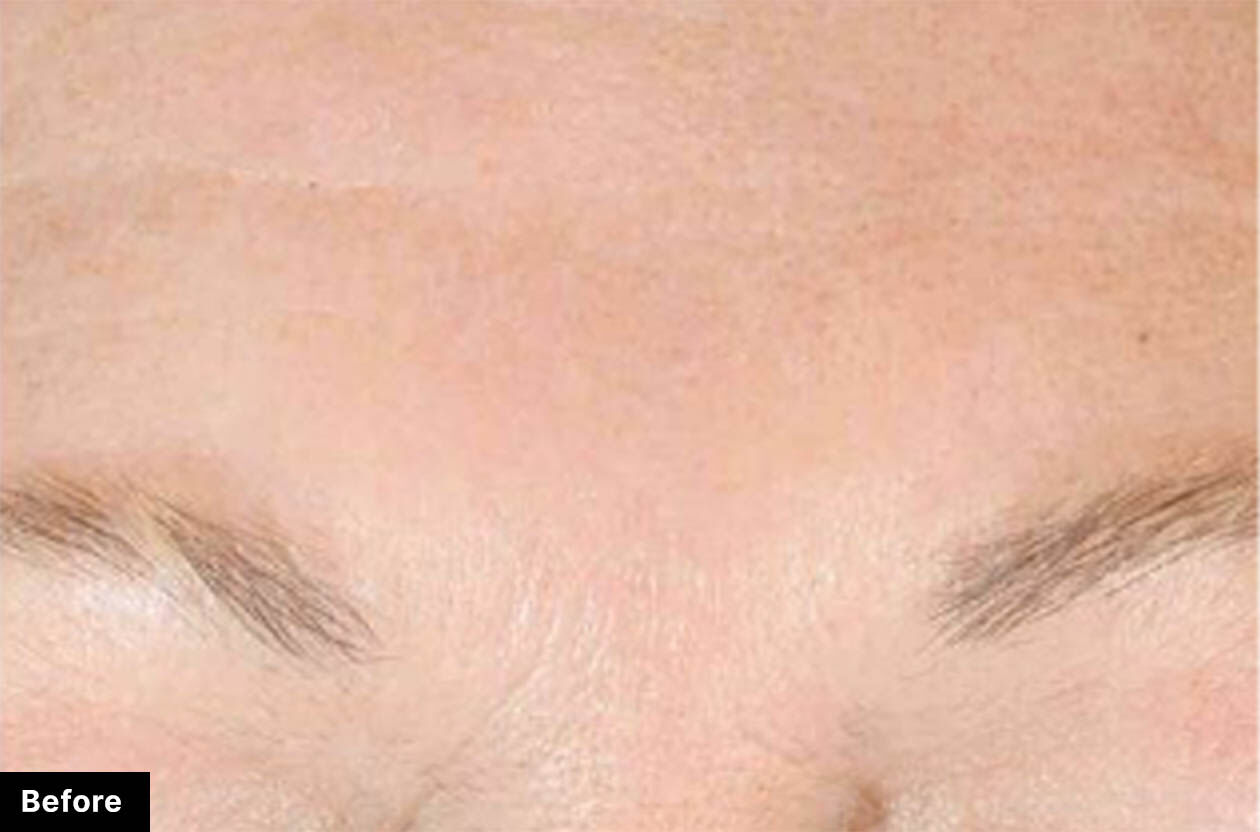 Close-up of a forehead and eyebrows, showcasing the skin texture and hair before a cosmetic treatment.