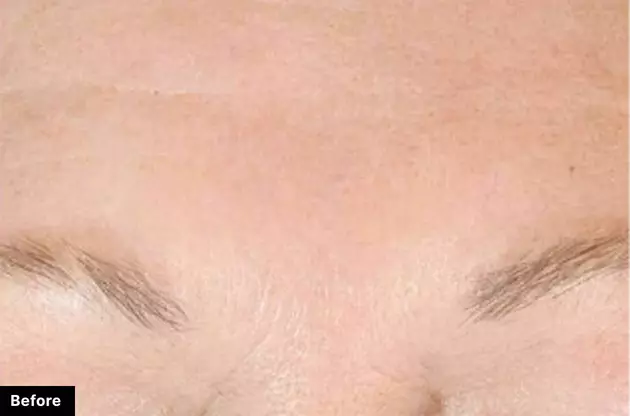 Close-up of a forehead and eyebrows, showcasing the skin texture and hair before a cosmetic treatment.