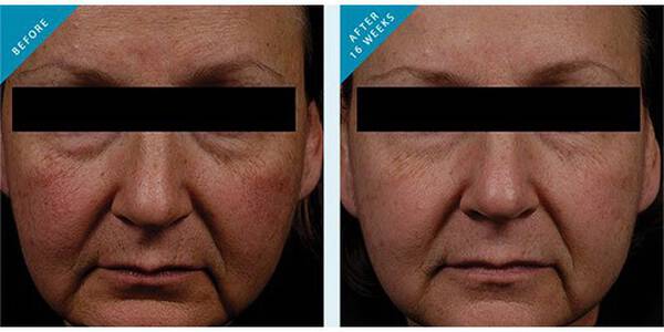 Phloretin CF before and after results