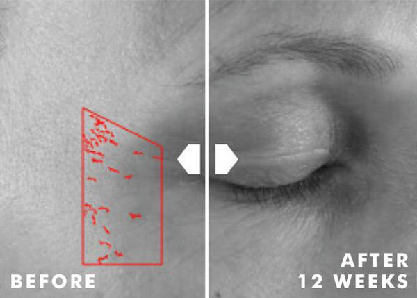 VISIBLE IMPROVEMENT IN CROW'S FEET