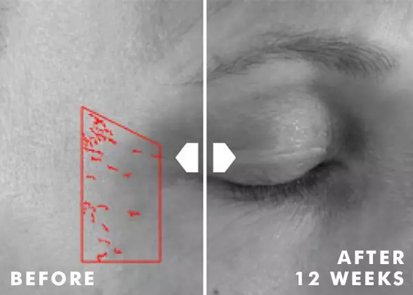 VISIBLE IMPROVEMENT IN CROW'S FEET