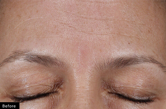 Close-up of a woman's forehead and closed eyes, highlighting skin texture and subtle wrinkles before treatment.
