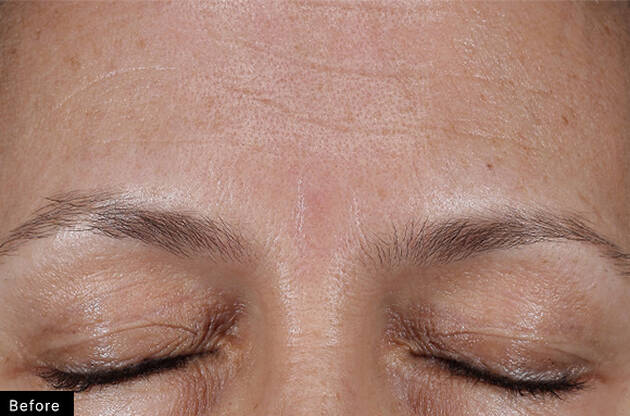 Close-up of a woman's forehead and closed eyes, highlighting skin texture and subtle wrinkles before treatment.