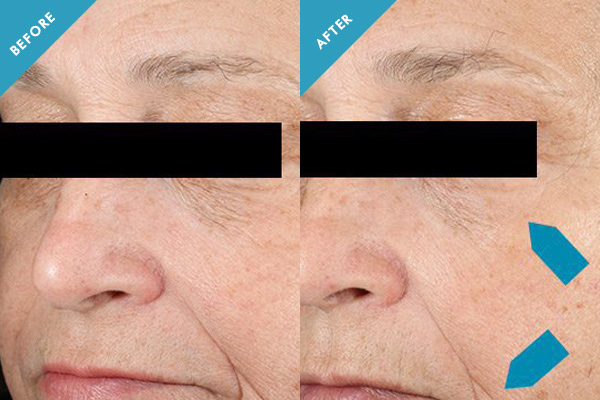 Before and after results