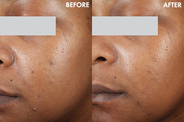 Before and after results