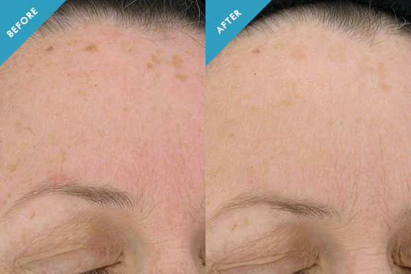 Before and after results