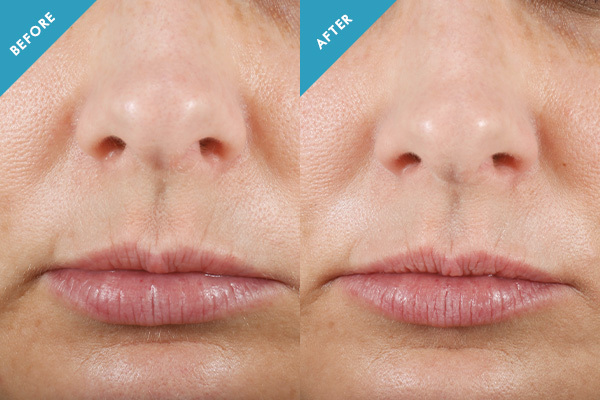 Before and after results