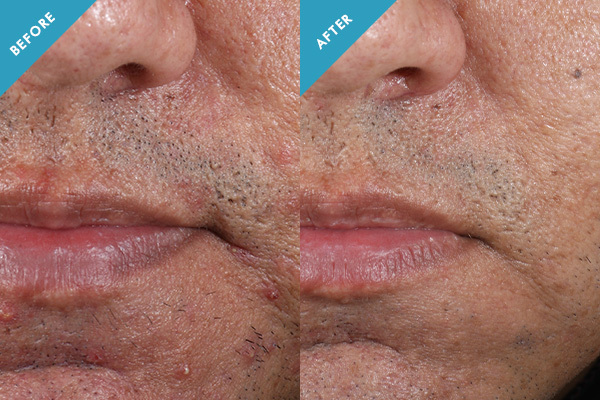 Before and after results