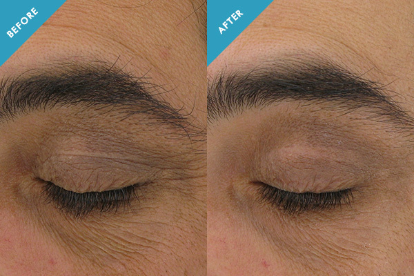 Before and after results