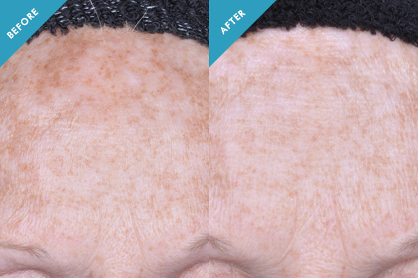 Before and after results