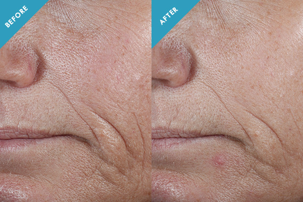 Before and after results