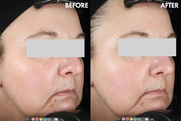 Before and after results
