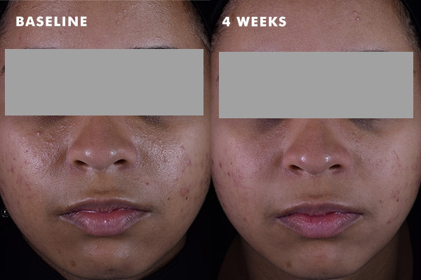 Before and after results