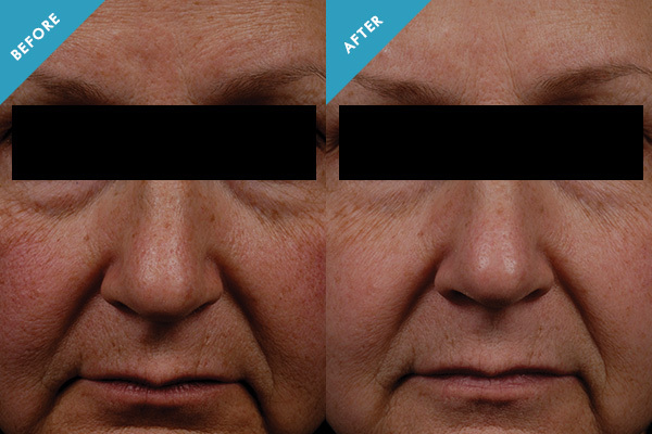 Before and after results