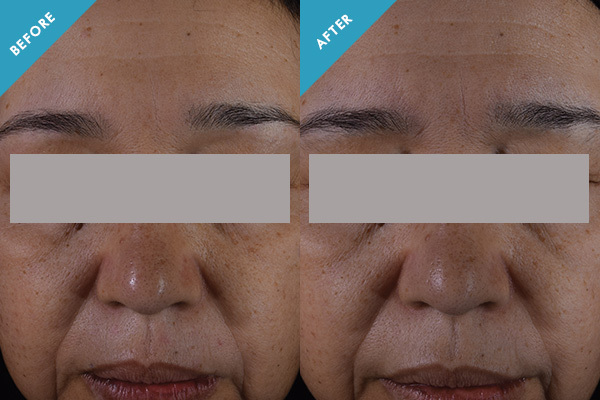 Before and after results