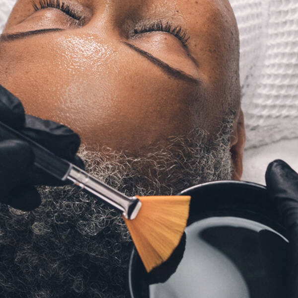 chemical peel treatment